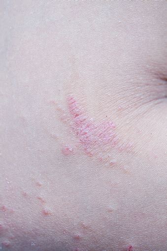 Itchy Skin Lesions From Allergies Skin Women Stock Photo Download