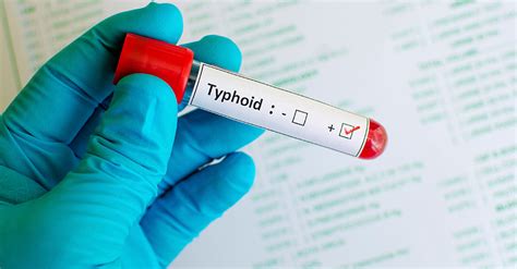 The History Of The Typhoid Fever Vaccine
