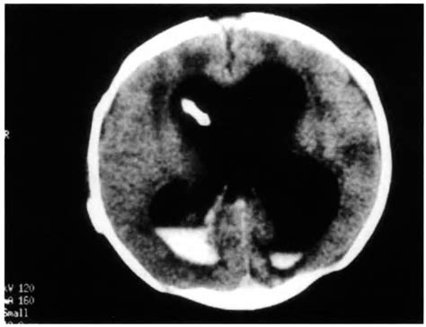 Intracranial Hemorrhage In A Newborn With Hemophilia Annals Of Saudi