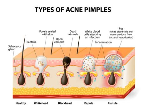 Different Types Of Pimples How To Cure Styles At Life