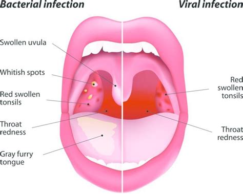337 Images Of Viral Throat Infection Images And Pictures Myweb