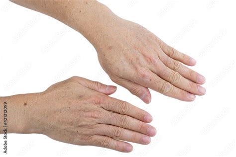 Small White And Brown Spots On The Skin Of Senior Man Hands And Arms