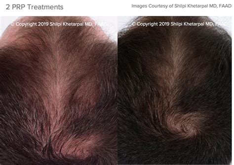 Hair Loss Treatment By A Greater Houston Tx Dermatologist