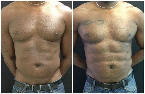 Abdominal Etching Before And After Photos In Fairfax And