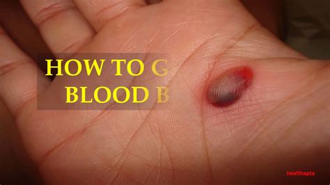 How To Get Rid Of Blood Blisters Youtube