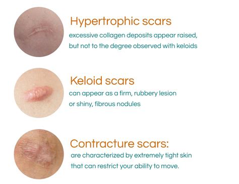 Follow these steps to recreate one of the most popularof styles of packing gel. What are scars? - Oo La La Cosmetic & Laser Clinic