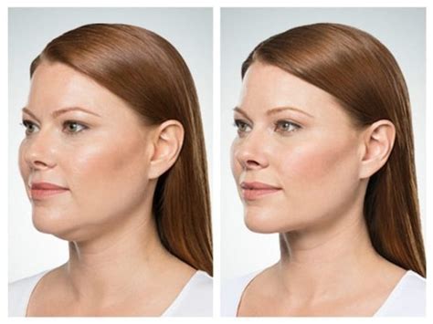 Kybella Injections Phx Double Chin Reduction Phoenix