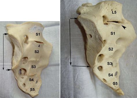 Variable Positions Of The Sacral Auricular Surface Classification And