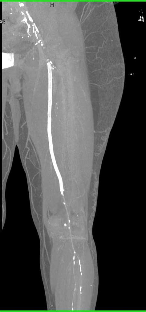Occluded Left Femoral Artery With Stent Graft Vascular Case Studies