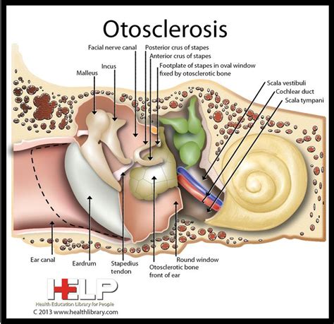 Otosclerosis Ear Anatomy Audiology Tinnitus Symptoms
