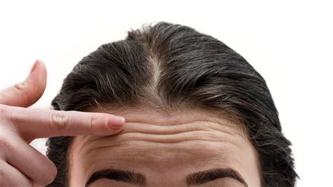 Forehead Wrinkles Causes And Treatment Minimalist