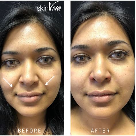Nose To Mouth Lines With Dermal Fillers Skinviva Manchester