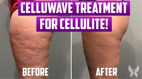 acoustic wave therapy for cellulite live treatment does celluwave therapy for cellulite work