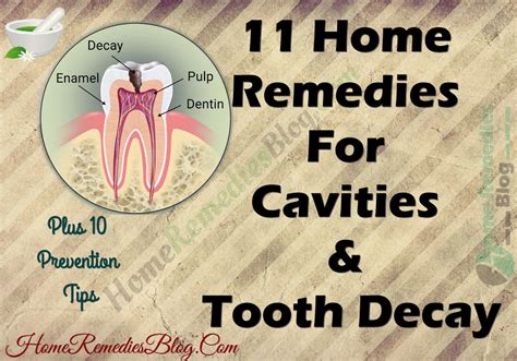 11 Home Remedies For Cavities And Tooth Decay Home Remedies Blog