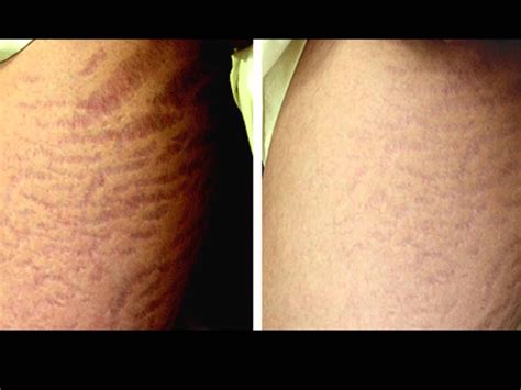 Derma Roller For Stretch Marks Before And After Results Stretch Mark