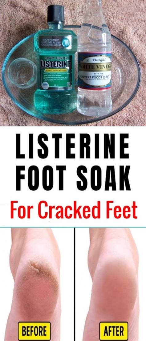 Listerine And Vinegar Foot Soak For Cracked Feet Foot Soak Vinegar