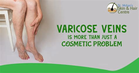 Varicose Veins Is A Very Serious Problem