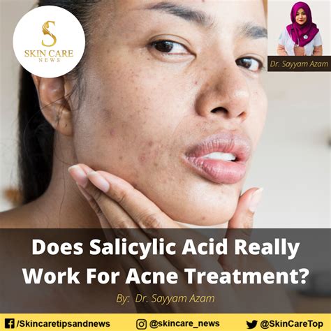 Does Salicylic Acid Really Work For Acne Treatment