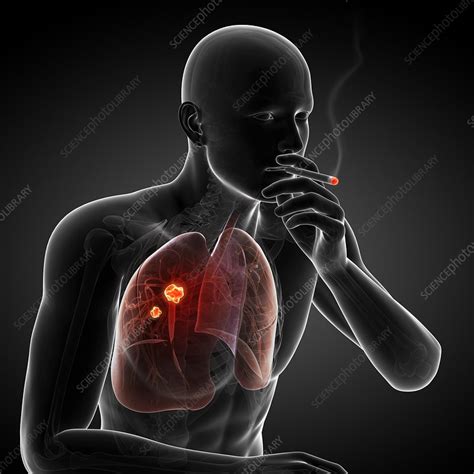 lung cancer due to smoking artwork stock image f007 6160 science photo library