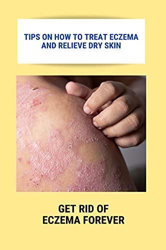 Tips On How To Treat Eczema And Relieve Dry Skin Get Rid Of Eczema