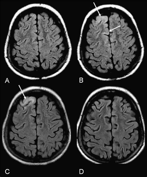 Superior Frontal Lobe Brain Mri Axial T2 Flair Images 15 T 5 Mm