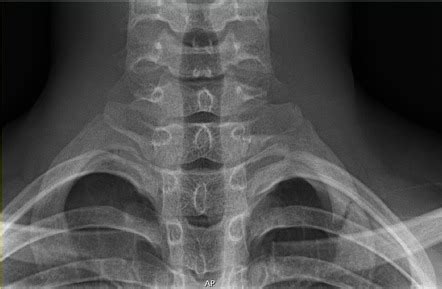 First Rib Radiology Reference Article Radiopaedia Org