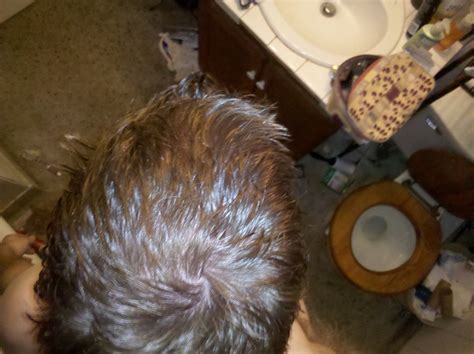 If you have thinning only in the crown, it may be just thinning only in the crown. Tressless: reddit's hair loss community for sufferers of ...