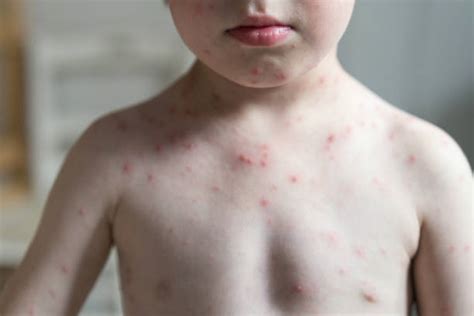 1000 Chickenpox Rash Stock Photos Pictures And Royalty Free Images