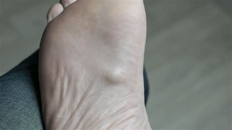 Is This Lump On My Foot Caused By Ledderhose Disease