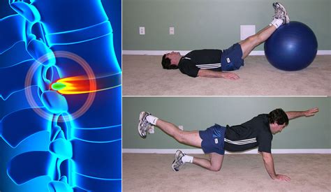 How to diagnose a herniated disc? Herniated Disc Exercises: Easy and Simple Moves for Pain ...
