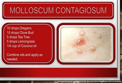 Molluscum Contagiosum Home Remedy List 15 Solutions Home Remedies