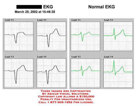 Somatic tremor, alternating current (ac), wandering baseline(poor lead you might also like. EKG and Normal EKG Comparison