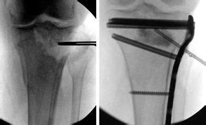 Fractures Of The Proximal Tibia Shinbone Orthoinfo Aaos Tibial