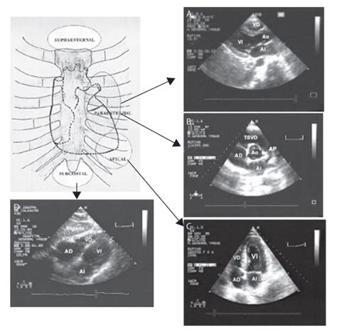 Papel De La Ecocardiografía En La Monitorización Hemodinámica De Los