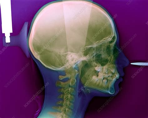 Dental X Ray Stock Image M7800601 Science Photo Library