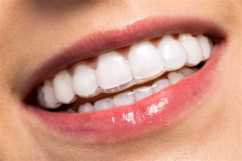 Straighten Teeth With Invisalign Clear Braces Regent