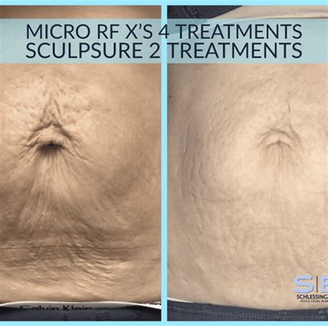Sculpsure Before And After Gallery Schlessinger Eye And Face Woodbury Ny
