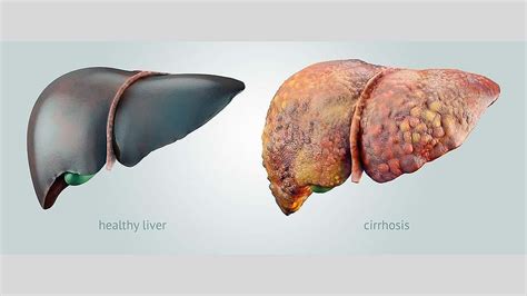 Cirrhosis Severe Liver Scarring