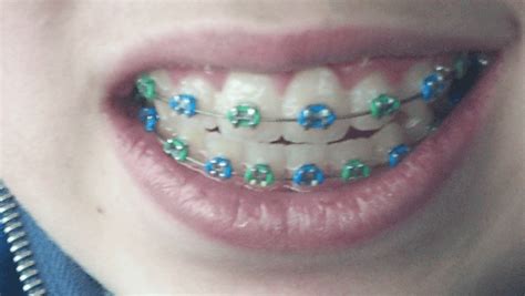 Blue Green Green Braces Black Braces Cute Braces Colors Adult Braces Brace Face Teeth