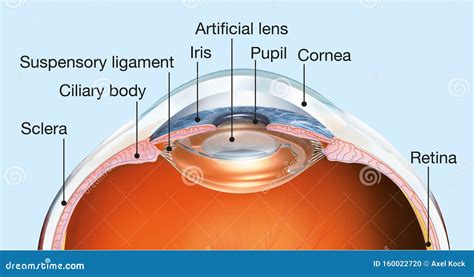 Human Eye With Artificial Lens Labeled Medically 3d Illustration
