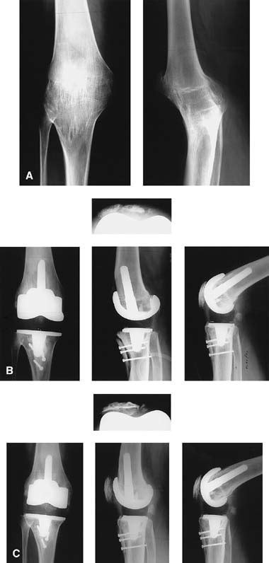 Total Knee Arthroplasty After Formal Knee Fusion Using Unconstrained