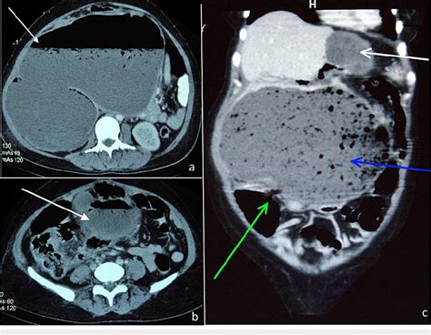 Figure 2 From Spontaneous Hepatic Hydatid Cyst Rupture Into The