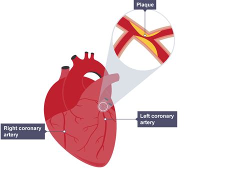 Coronary Artery Disease Clip Art Cliparts