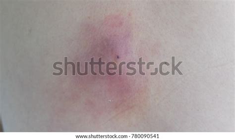 Infected Sebaceous Cyst Complicated Abscess Formation Stock Photo