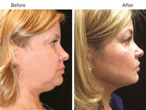 Kybella In Pittsburgh Pa Treat Your Double Chin In Columbus Oh