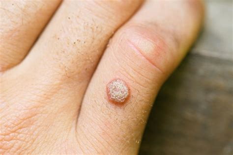 Do Warts Go Away On Their Own Holladay Dermatology And Aesthetics