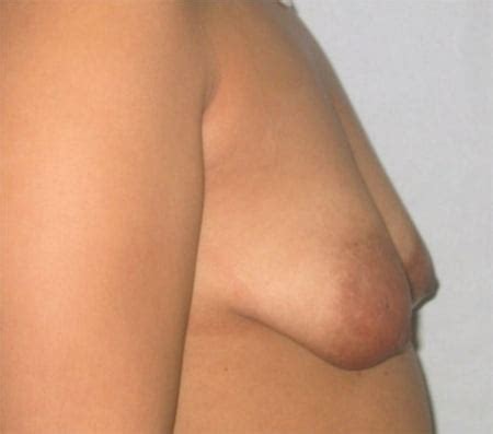 Puffy And Malformed Tits Lovely Areolas Plastic Surgery Porn Pictures