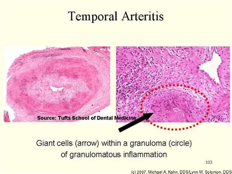 Temporal Arteritis Causes Symptoms Treatment Temporal Arteritis