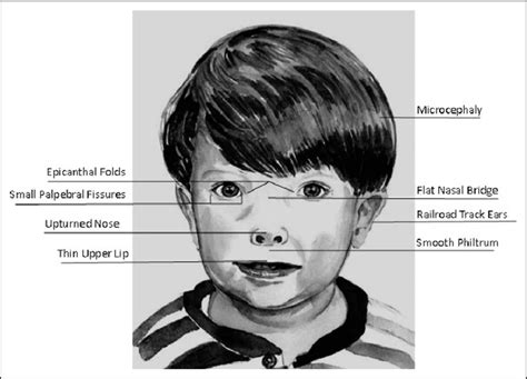 characteristic facial features in fetal alcohol spectrum disorders download scientific diagram