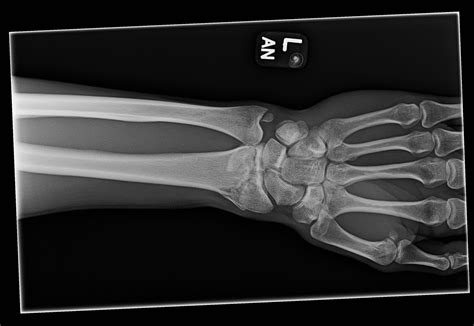 Avulsion Fracture Of Styloid Process Of Ulna